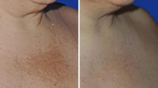 mesopeel-before-and-after-1