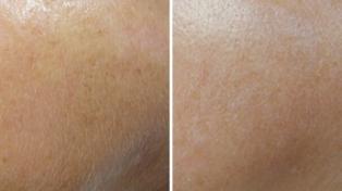 mesopeel-before-and-after-2