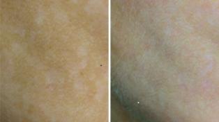 mesopeel-before-and-after-3